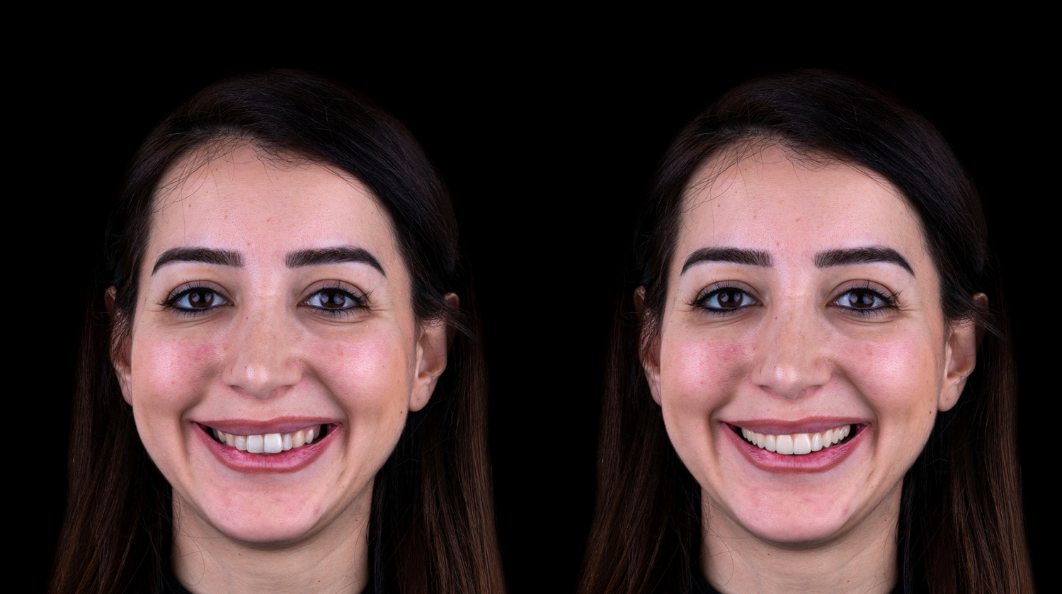 DTS Diastema Closure Simulation